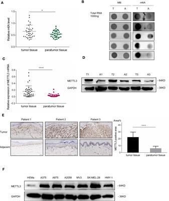 m6A Methyltransferase METTL3 Promotes the Progression of Primary Acral Melanoma via Mediating TXNDC5 Methylation